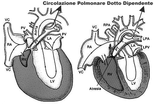 Fisiopatologia Clinica Esame obiettivo: Soffio sistolico sul focolaio tricuspide Rullio tricuspidalico (IT severe) Soffio