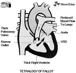 Cardiopatie Congenite Cardiopatie con ipoafflusso polmonare Anatomia Deviazione anteriore del setto infundibulare Cavalcamento aortico Difetto interventricolare da maleallineamento Ostruzione