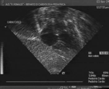 Ecocardiografia 2D color Doppler Deviazione anteriore del setto infundibulare Diametro dell