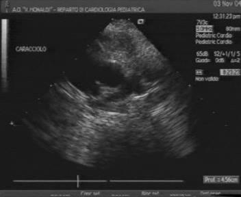 Diagnosi: Ecocardiografia 2D color Doppler Storia naturale Rami polmonari ( APD + APS/Ao disc > 1.
