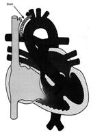 homograft Chirurgia Radicale Risultati Chirurgia Riparazione chirurgica ottimale Diametro dell anulus polmonare Anatomia delle arterie polmonari