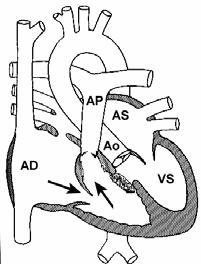 ipoplasiche Anomalie delle arterie polmonari ( agenesia o origine anomala) Anulus polmonare piccolo Età >3 anni Mortalità precoce: 1-5%