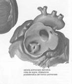 Patologia con ostruzione all efflusso ventricolare destro Congenita Può localizzarsi a diversi livelli Valvolare Sopra-valvolare Infundibolare Rami polmonari <50mmHg:lieve