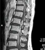 TRAUMA DORSO-LOMBARE RM