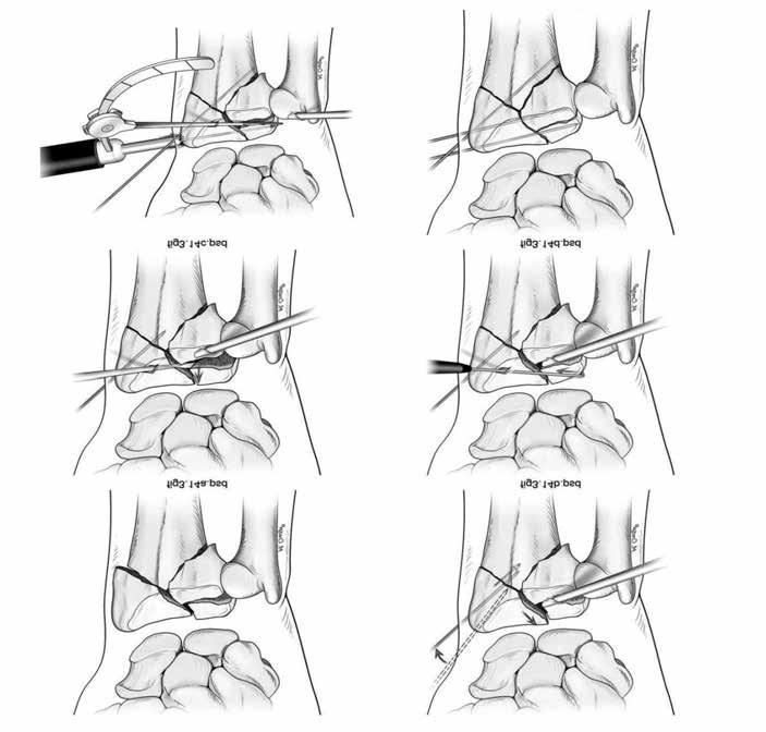 From Arthroscopic Management of distal radius fractures Chapter 3 Battistella Springer FIG.