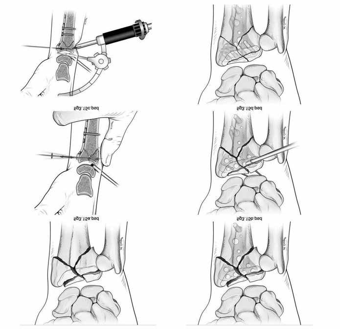 From Arthroscopic Management of distal radius fractures Chapter 3 Battistella Springer FIG.