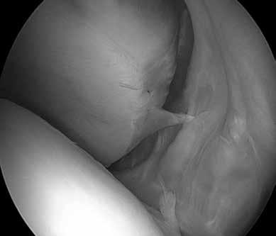 FIG. 1 - Assenza della radice anteriore del menisco mediale successive a meniscectomia subtotale per pregressa rottura a manico di secchia.