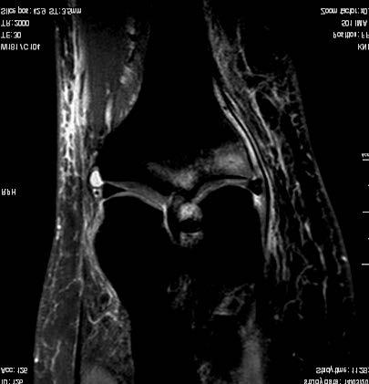 FIG. 3 - Estrusione del menisco mediale sul piano medio-coronale. Evidente l edema osseo reattivo al sovraccarico funzionale sia al femore sia alla tibia.