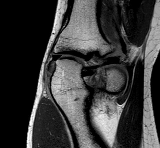 eminenza tibiale laterale. 45 La sensibilità e la specificità della RMN per il rilevamento delle lesioni della radice del menisco laterale non sono tuttavia ancora note.