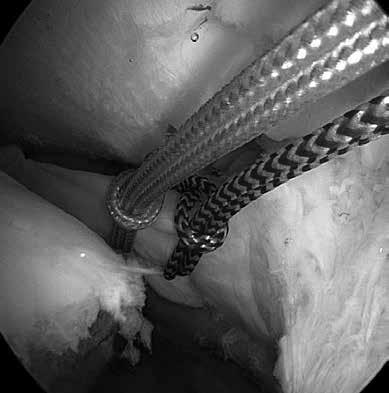 (Fig. 7). Nella tecnica transtibiale utile è l impiego di un retrodrill (Fig. 8) FIG. 8 - Retro-drill utilizzato nella tecnica transtibiale. con una direzione leggermente diversa sul piano coronale.