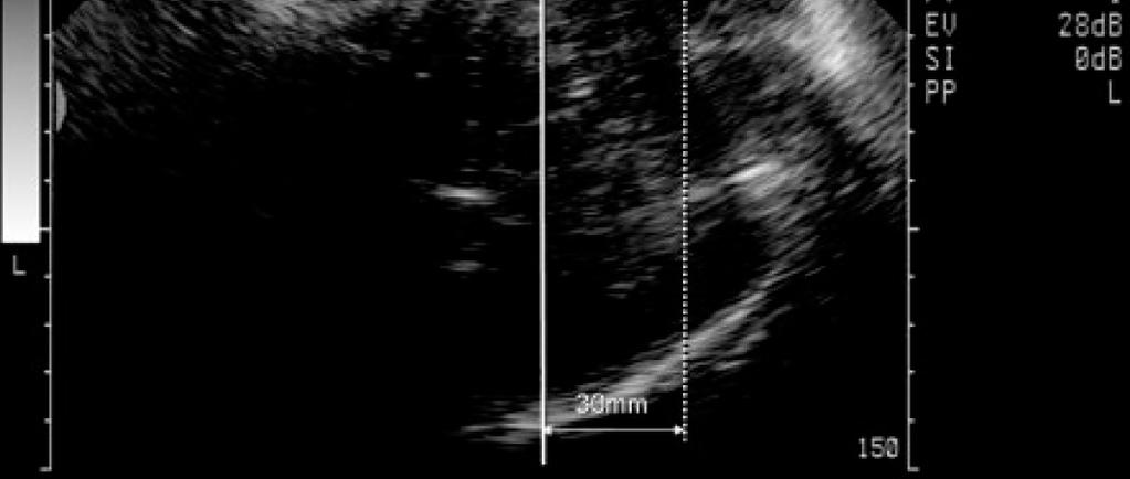 Infrapubic line 15 W. Henrich.