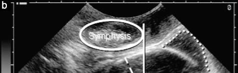 Sonographic Landmarks head up.