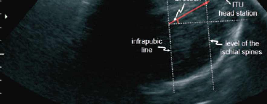 The parallel plane through the ischial spines is 3 cm below the