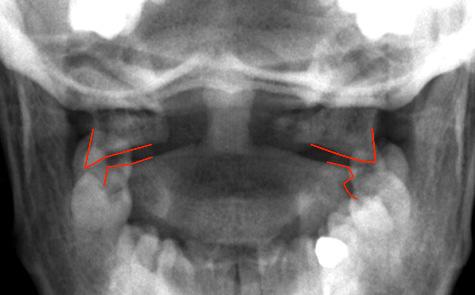 Jefferson Fracture Frattura