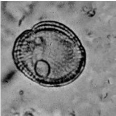 magnetica, radiografia (calcificazioni) Diagnosi difficile!