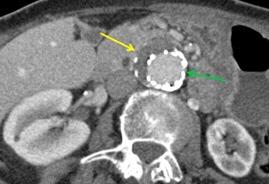 Eco contrasto Può essere utile nell individuazione dell endoleak di tipo II (a basso flusso) erroneamente diagnosticato all