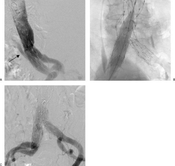 Endoleak tipo IB Nell individuazione dell endoleak l angiografia digitale è inferiore all angio-tc e all