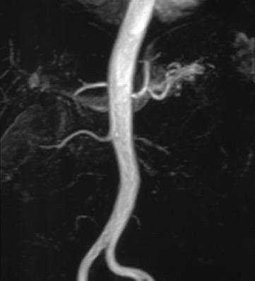 MRA nelle arterie renali Ospedale CIVICO Palermo