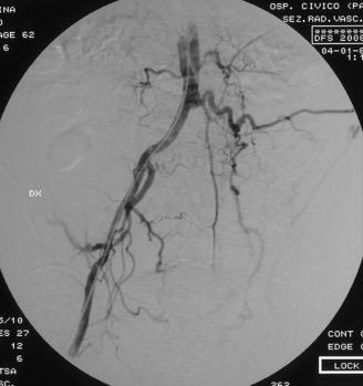 MRA nella Malattia aorto-occlusiva