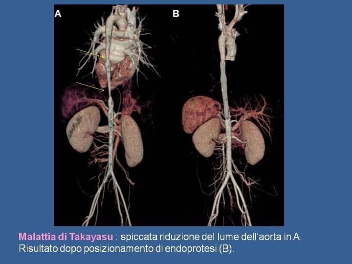 Malattia di Takayasu : spiccata riduzione del lume dell aorta a sn.