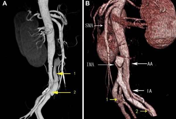 dissecazione isolata delle arterie iliache e dell aorta addominale sotto-renale con parziale trombosi del falso lume in aorta addominale; l a.