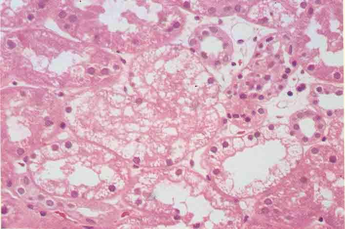 NECROSI TUBULARE ACUTA DA NEFROTOSSINE TOSSICI ESOGENI FARMACI Aminoglicosidi Cefalosporine Ciclosporina A Chemioterapici Altri METALLI PESANTI Mercurio