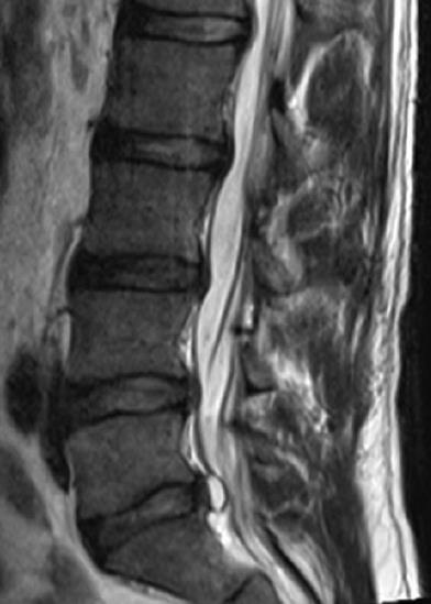 Diagnostica per immagini RMN lombo-sacrale artrosi delle faccette articolari da L2 a L5 con