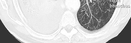 Prevalente sviluppo centrale Sviluppo endoluminale con stenosi bronchiale: atelettasia Possibile necrosi centrale con formazione di cancro