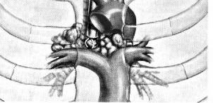 CARCINOMA DEL POLMONE MEDIASTINOSCOPIA Anestesia generale Inserimento del mediastinoscopio attraverso una incisione della cute subito sopra