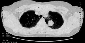 diagnosi di metastasi a distanza Maggior accuratezza di staging