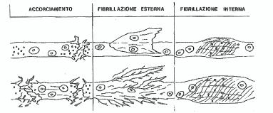 Per ovviare a questi problemi si è ricorso alla sbianca per opera del biossido di cloro o acqua ossigenata ed all ossigeno, nascenti da soli o in combinazione ed a più stadi.