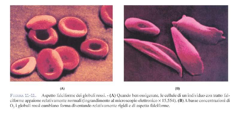 Emoglobina S (HbS) e anemia falciforme Una mutazione determina la sostituzione dell ac.