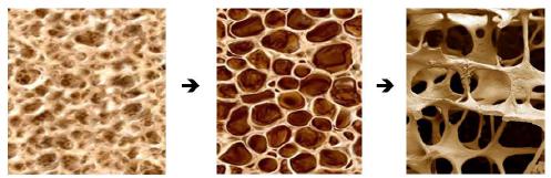 OSTEOPOROSI: DEFINIZIONE L osteoporosi è una malattia sistemica dello scheletro caratterizzata da una riduzione della massa ossea e da alterazioni