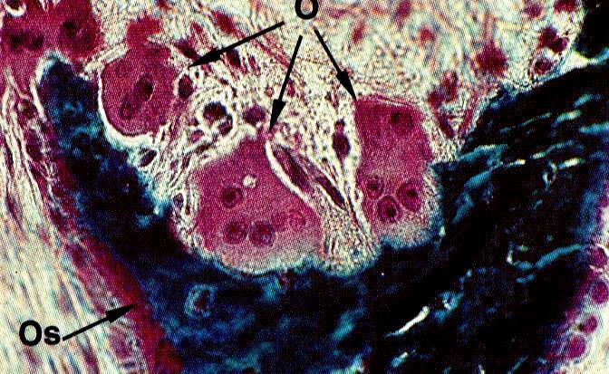 Osteoclasti -cellule deputate al riassorbimento osseo