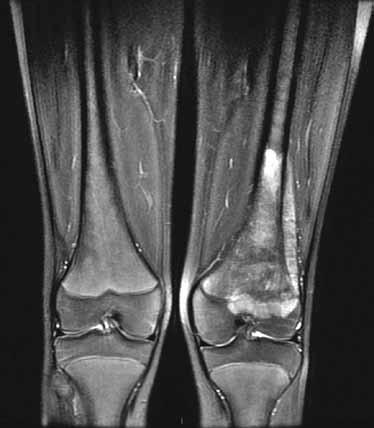 2 Sezione assiale di TC del ginocchio sinistro che mostra un osteosarcoma a carico del femore distale ricevere informazioni sulla diffusione del tumore nell osso, lungo il canale midollare della