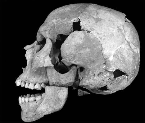 7. - Lesione da fendente su branca mandibolare e processo mastoideo del lato sinistro dellʼindividuo della tomba n. 53. 8.