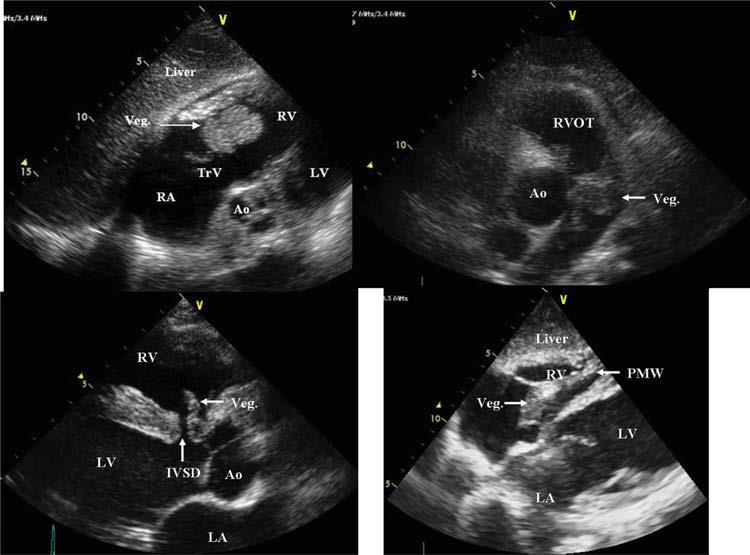 Endocarditi