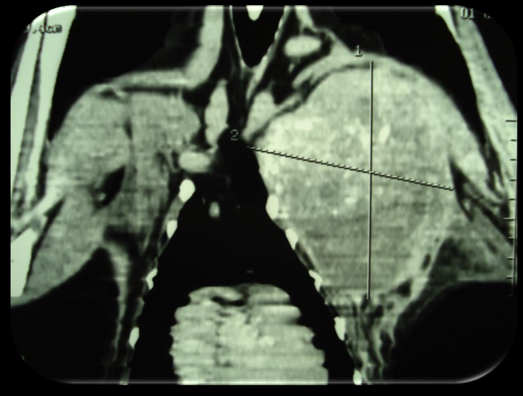 Resistenza fisiologica Volume eccessivo della neoplasia Presenza di aree