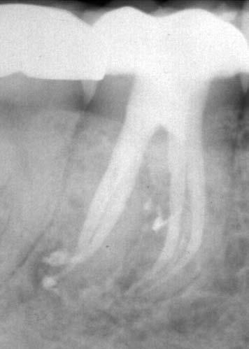 L Informatore Endodontico Vol.2, Nr.3 dell imbocco canalare, senza applicare alcuna pressione sul cono backfilling.