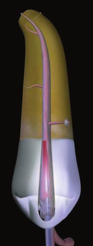 guttaperca, in maniera da penetrare almeno fino a metà dello spazio del backfill (Fig. 10b).