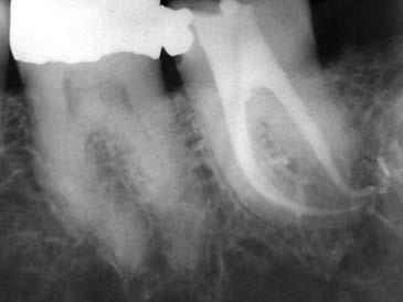 L Informatore Endodontico Vol.2, Nr.3 7 La misura medium (conicità.10) e la misura medium-large (conicità.