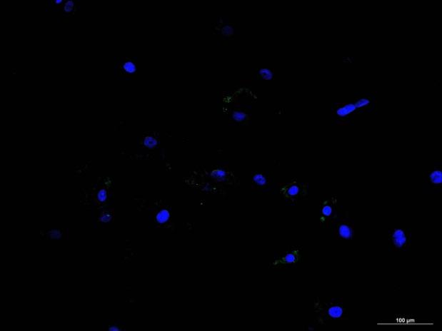 E-caderina vimentina Cellule LAM/TSC S A MCF7 Cellule LAM/TSC S A COS7 SNAIL Rosso: vimentina Verde: E-caderina Fig.