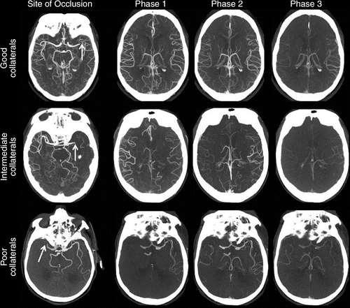 Multiphase CT Angiography: A New Tool for the Imaging Triage of Patients with Acute Ischemic Stroke Bijoy K.