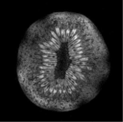 Differenze dopo 90 gg Parametrizzazione delle immagini T 2a : S 1 S 2 S 3 S 4 S 5 (0 gg) 39 ± 8 38 ±5 36 ± 3 44 ± 4 35 ± 4 (90 gg) 54 ± 9 46 ± 5 44 ± 2 45 ± 2 41 ± 5 (0 gg) 45 ± 5 43 ± 4 44 ± 6 45 ±