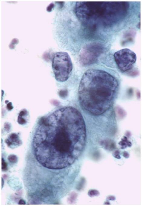 Criteri Carcinoma squamoso non cheratinizzante Le cellule si presentano Isolate o in aggregati similsinciziali Le cellule