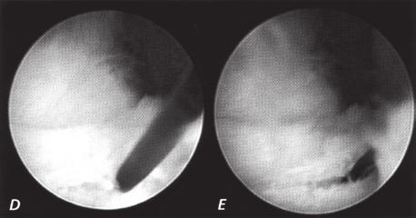 La fibrocartilagine triangolare è stata reinserita artroscopicamente in 22 pazienti (17 tipo 1B e 5 tipo 1C).