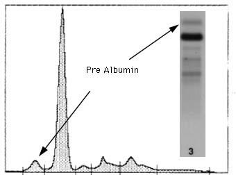 Prealbumina La prealbumina (o transtiretina) è la banda più anodica. È di sintesi epatica, ha un peso molecolare di 54-61 kda e struttura tetramerica. Ha un emivita di 2 giorni e varia con l età.