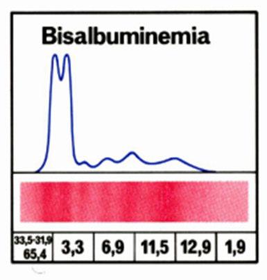 Albumina Bisalbuminemia Varianti genetiche dell albumina visibili per la presenza di due bande: una con la stessa mobilità dell albumina normale, l altra con