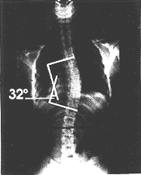 LA SCOLIOSI RADIOLOGIA Importante valutare lo stato di maturità dello scheletro