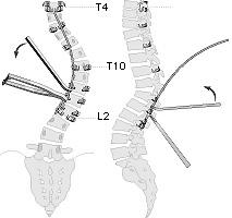 scoliotica >35-40 di Cobb.